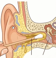Nettoyeur d'oreilles KHAELLIA
