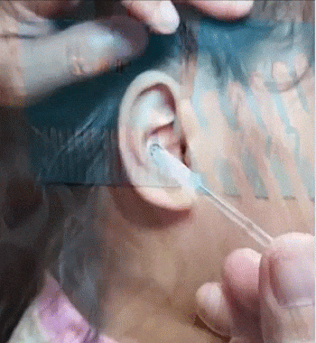 Nettoyeur d'oreilles KHAELLIA
